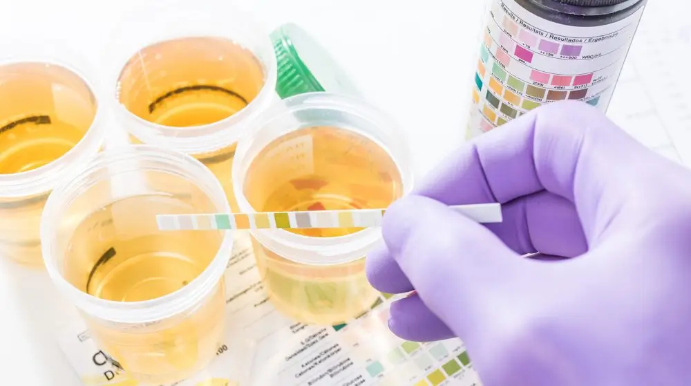 Understanding Proteinuria and Its Impact on Kidney Health
